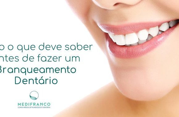 Branqueamento dentário- Tudo o que deve saber em 8 perguntas!